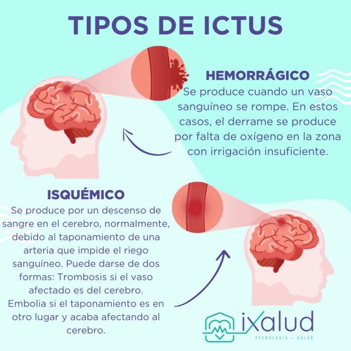 Secuelas tras sufrir un ictus | 
