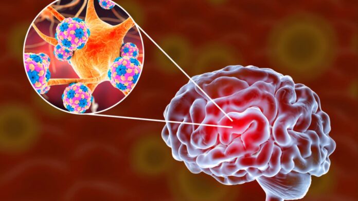 Complicaciones de la encefalitis -