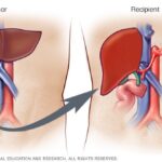 Desarrollan pequeños hígados satélites como alternativa al trasplante Trasplante de hígado: Antes de la cirugía de su hijo |