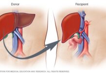 Desarrollan pequeños hígados satélites como alternativa al trasplante Trasplante de hígado: Antes de la cirugía de su hijo |